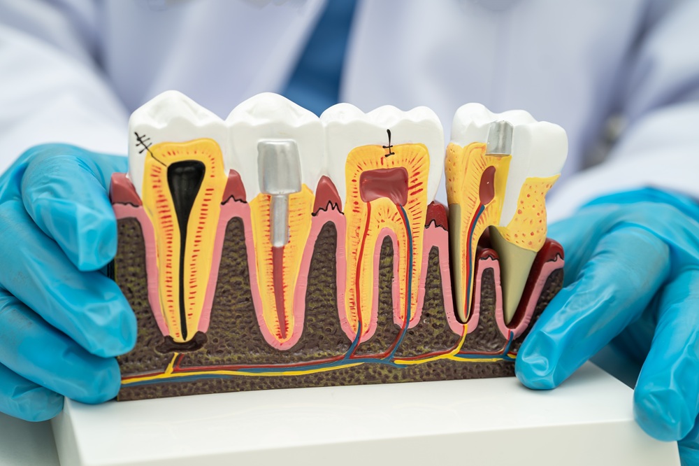 Tooth Model Showing Root Canal Treatment Stages – Root Canals A close-up of a dental model displaying the stages of root canal therapy, highlighting how the inside of the tooth is cleaned, filled, and sealed. – Root Canals