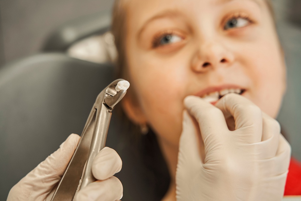 Child After Tooth Extraction at Dentist – Extractions A young patient smiles after a gentle tooth extraction, as the dentist carefully holds the removed tooth with sterile dental forceps. – Extractions